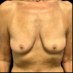 Breast Augmentation Before & After Patient #4330