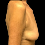 Breast Augmentation Before & After Patient #4330