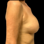 Breast Augmentation Before & After Patient #4330