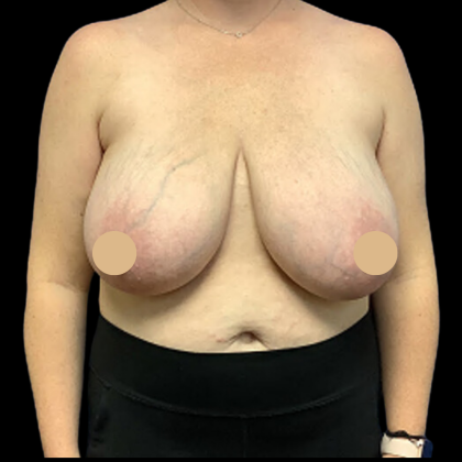Breast Reduction Before & After Patient #4337
