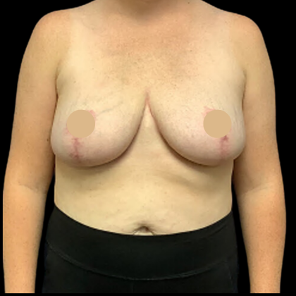 Breast Reduction Before & After Patient #4337