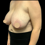 Breast Reduction Before & After Patient #4337