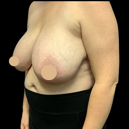 Breast Reduction Before & After Patient #4337