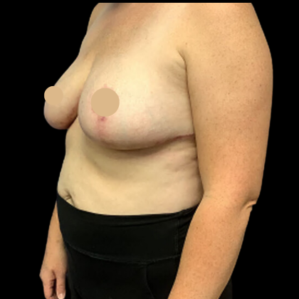 Breast Reduction Before & After Patient #4337