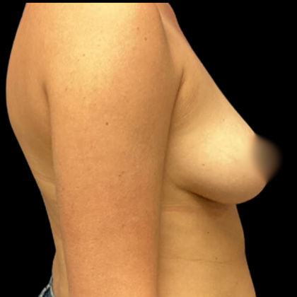 Breast Augmentation Before & After Patient #4344