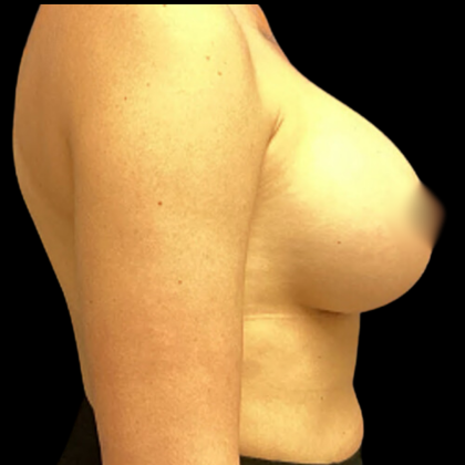 Breast Augmentation Before & After Patient #4344