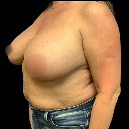 Implant Removal Before & After Patient #4349