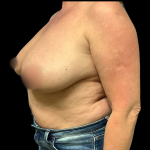 Implant Removal Before & After Patient #4349
