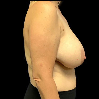 Breast Reduction Before & After Patient #4356