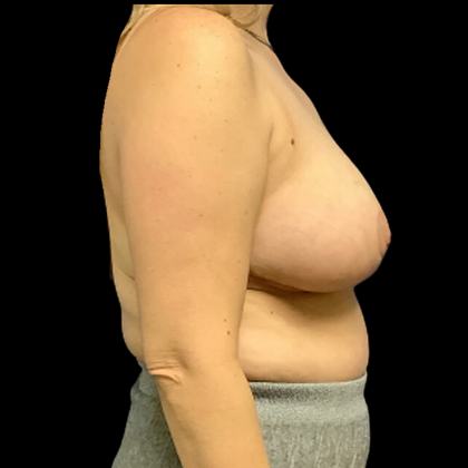 Breast Reduction Before & After Patient #4356