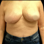 Breast Reduction Before & After Patient #4447