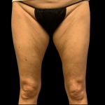 Liposuction Before & After Patient #4448
