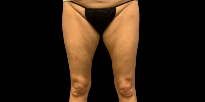 Liposuction Before & After Patient #4448