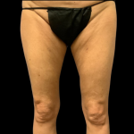 Liposuction Before & After Patient #4448
