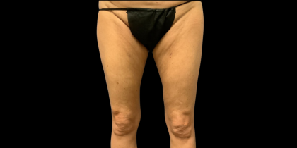 Liposuction Before & After Patient #4448