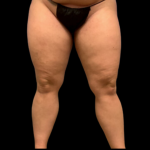 Liposuction Before & After Patient #4359