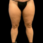 Liposuction Before & After Patient #4359