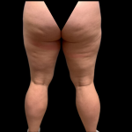 Liposuction Before & After Patient #4359