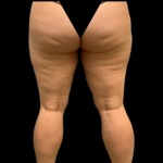 Liposuction Before & After Patient #4359
