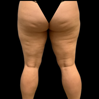 Liposuction Before & After Patient #4359