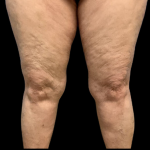Liposuction Before & After Patient #4360