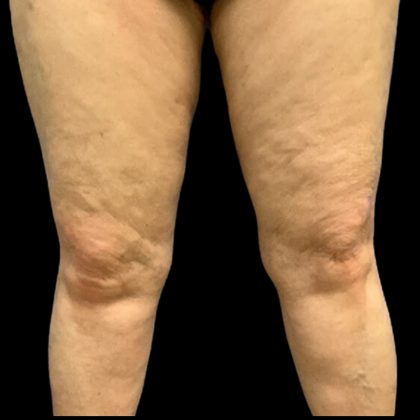 Liposuction Before & After Patient #4360