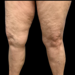 Liposuction Before & After Patient #4360