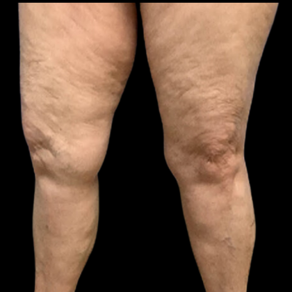 Liposuction Before & After Patient #4360