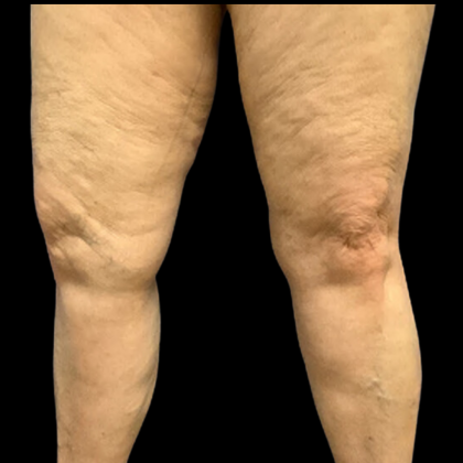 Liposuction Before & After Patient #4360