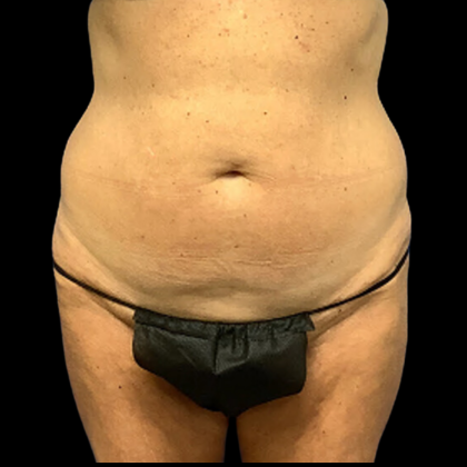 Tummy Tuck Before & After Patient #4361