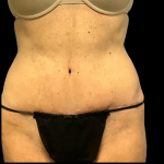 Tummy Tuck Before & After Patient #4361