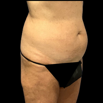 Tummy Tuck Before & After Patient #4361