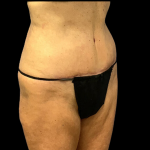 Tummy Tuck Before & After Patient #4361