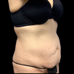 Tummy Tuck Before & After Patient #4365