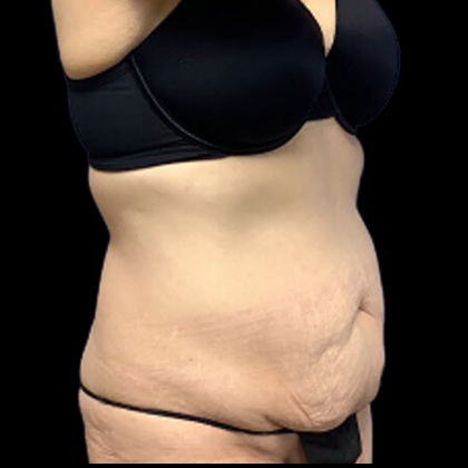 Tummy Tuck Before & After Patient #4365