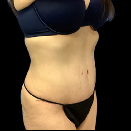Tummy Tuck Before & After Patient #4365