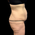 Tummy Tuck Before & After Patient #4365