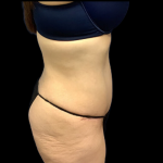 Tummy Tuck Before & After Patient #4365
