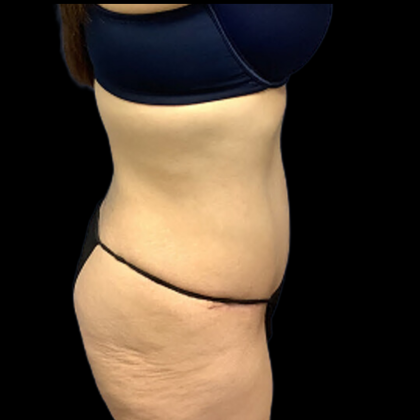 Tummy Tuck Before & After Patient #4365