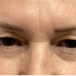 Blepharoplasty Before & After Patient #4634