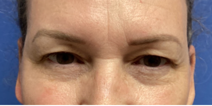 Blepharoplasty Before & After Patient #4634