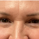 Blepharoplasty Before & After Patient #4634