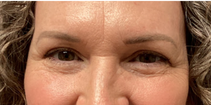 Blepharoplasty Before & After Patient #4634