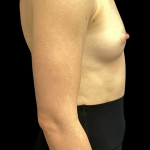 Breast Augmentation Before & After Patient #4454