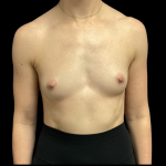 Breast Augmentation Before & After Patient #4369