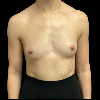 Breast Augmentation Before & After Patient #4369