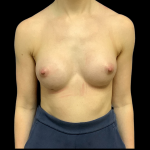 Breast Augmentation Before & After Patient #4369