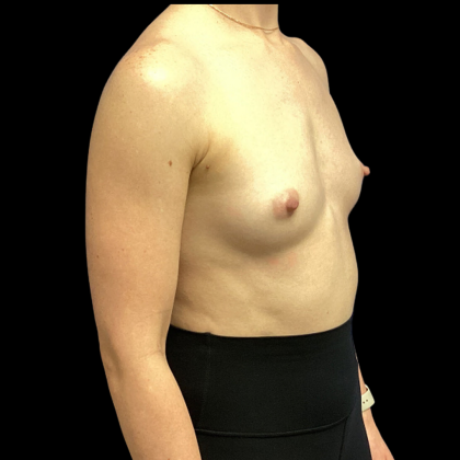 Breast Augmentation Before & After Patient #4369