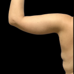 Arm Lift Before & After Patient #4453