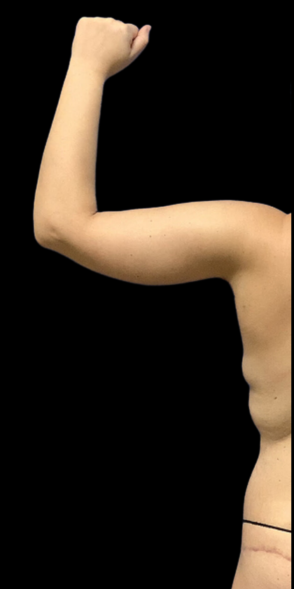 Arm Lift Before & After Patient #4453